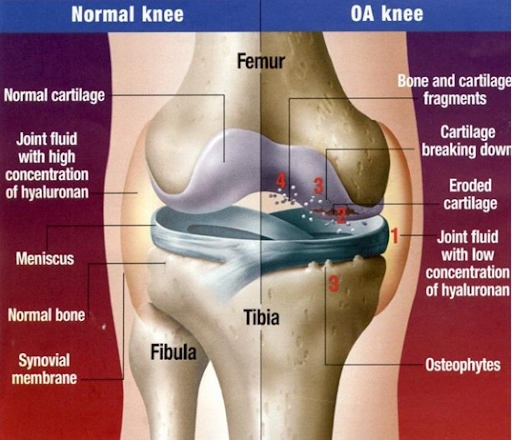 Diagram demonstrating normal knee configuration compared to arthritic knees 